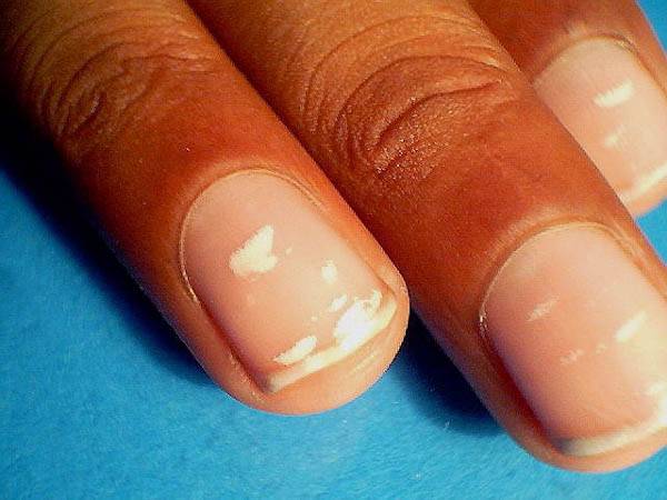 Leuconiquia – Manchas blancas en tus uñas, InfoMistico.com