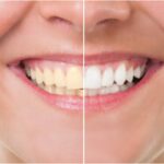 Activated Charcoal for Teeth Whitening, InfoMistico.com