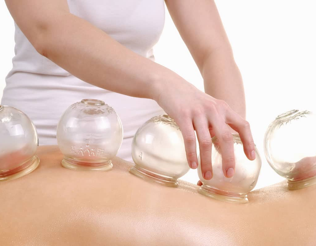 Cupping Therapy, InfoMistico.com
