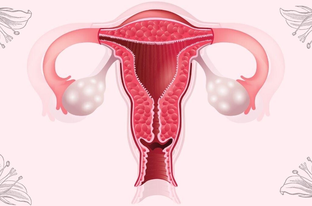 Síndrome de Ovario Poliquístico, InfoMistico.com