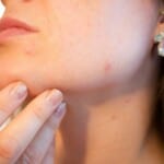 Acne and Self-Protection: A Biodecoding Perspective, InfoMistico.com