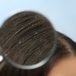Dandruff and Biodecoding: Understanding Your Hair Wellness, InfoMistico.com