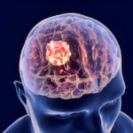 Brain Tumor Biodescodification, InfoMistico.com